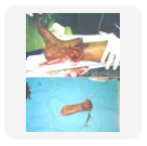 amputation.jpg